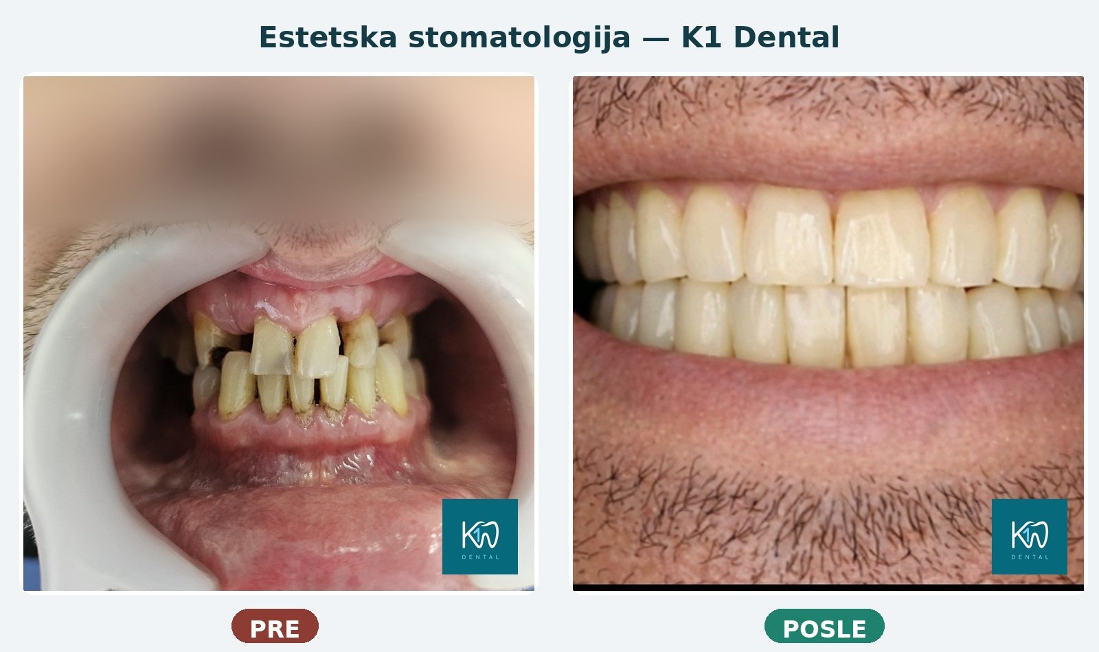 Pre i posle estetske stomatologije - K1 Dental