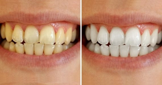 k1 dental belejnje zuba stomatolog beograd